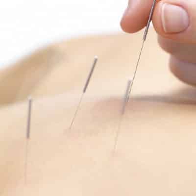 Dry needling behandeling van een triggerpoint